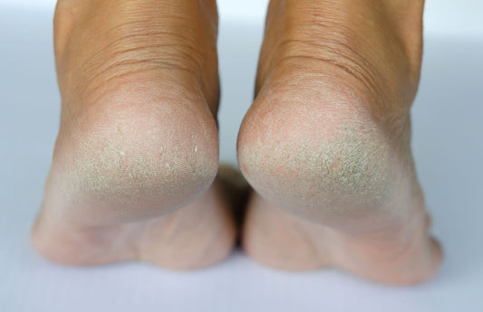 How to Fix Dry, Cracking Feet